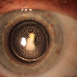 lente multifocal intraocular