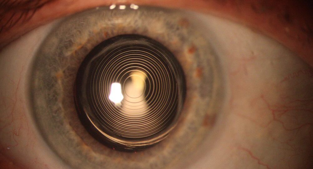 lente multifocal intraocular