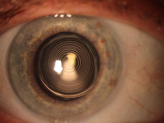 lente multifocal intraocular